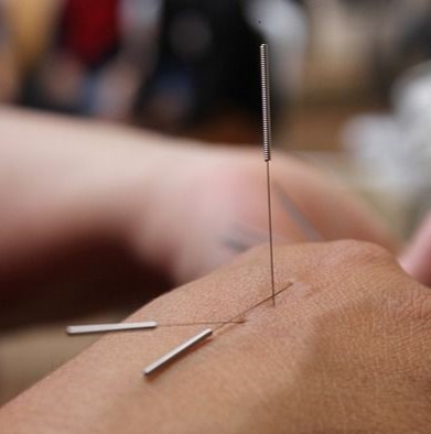 Acupuncture Treatment